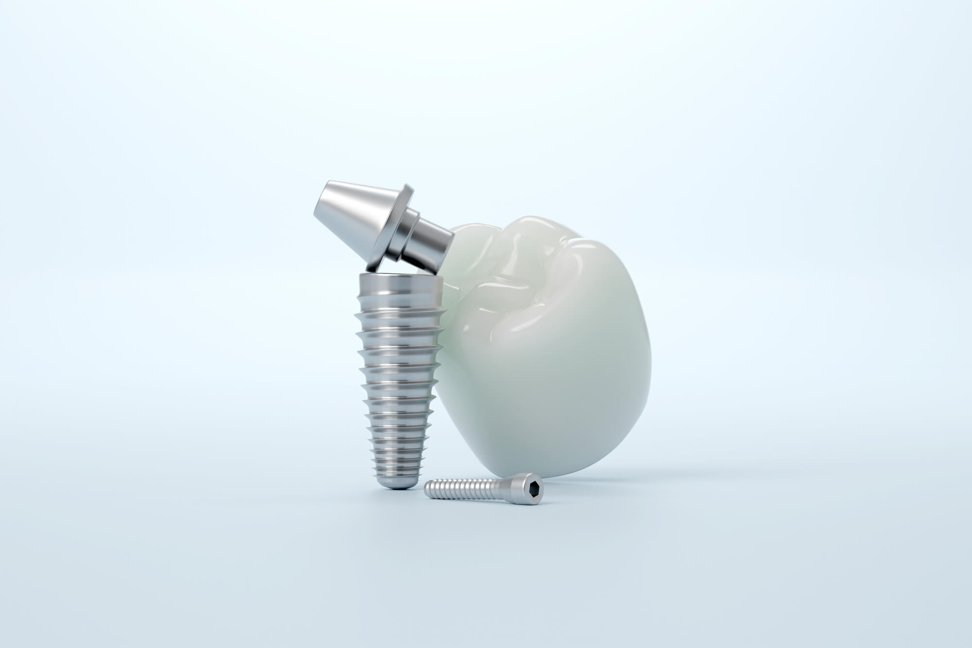 インプラントの構造とは？インプラントの材質や種類、治療回数を解説