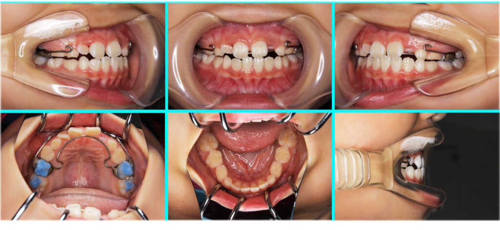 46] 反対咬合・こどもの矯正治療｜たまむら矯正歯科｜尼崎・伊丹の矯正