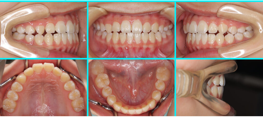 46] 反対咬合・こどもの矯正治療｜たまむら矯正歯科｜尼崎・伊丹の矯正