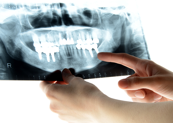 低被ばくのデジタルレントゲンを導入｜喜んでいただいている10の理由