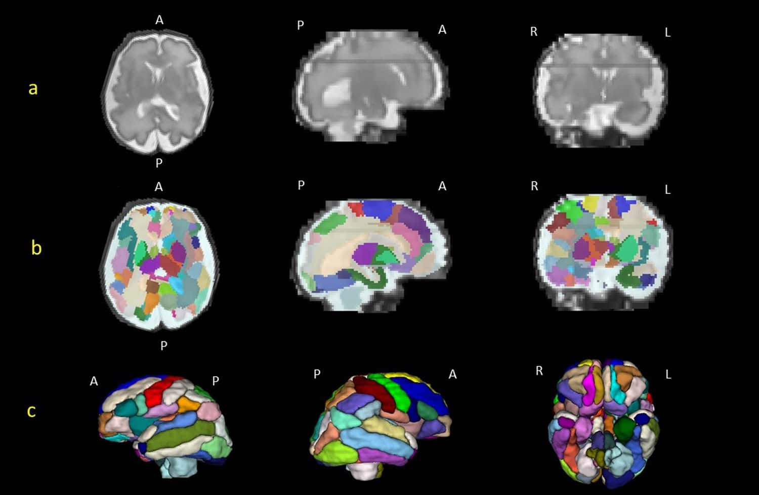 Prenatal brain scans could reveal autism-associated brain