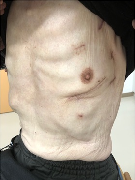 低侵襲心臓手術｜社会医療法人禎心会 札幌禎心会病院