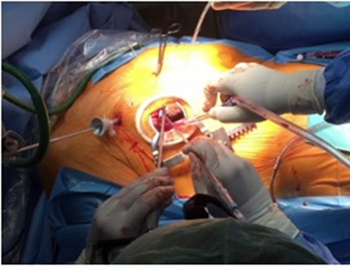 低侵襲心臓手術｜社会医療法人禎心会 札幌禎心会病院