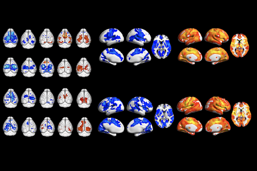 Too much or too little brain synchrony may underlie autism