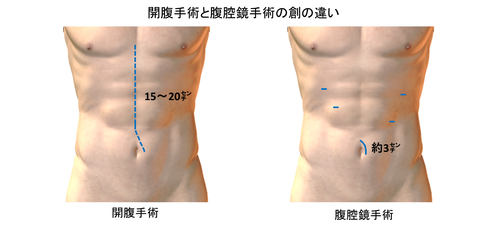 腹腔鏡下・ロボット支援下胃切除術 - 総合病院 土浦協同病院