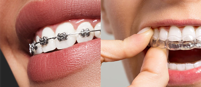 インビザライン （マウスピース型矯正装置） - スマイルデザイン歯科