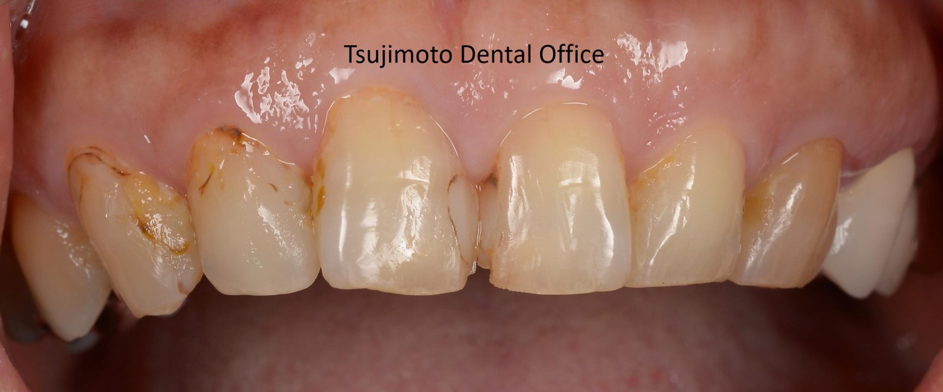 審美治療 | 福岡市中央区の歯医者・歯科なら大濠公園駅近くの辻本