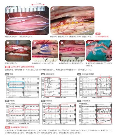 機能神経外科 痙縮(脳性麻痺など) | 東京女子医科大学脳神経外科