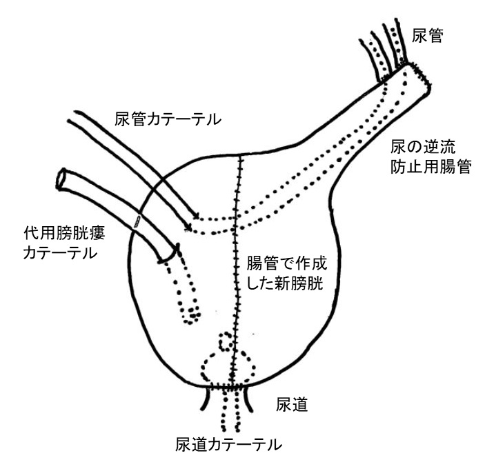 腹腔鏡下膀胱全摘除術 尿路変向（自然排尿型代用膀胱造設術、回腸導管