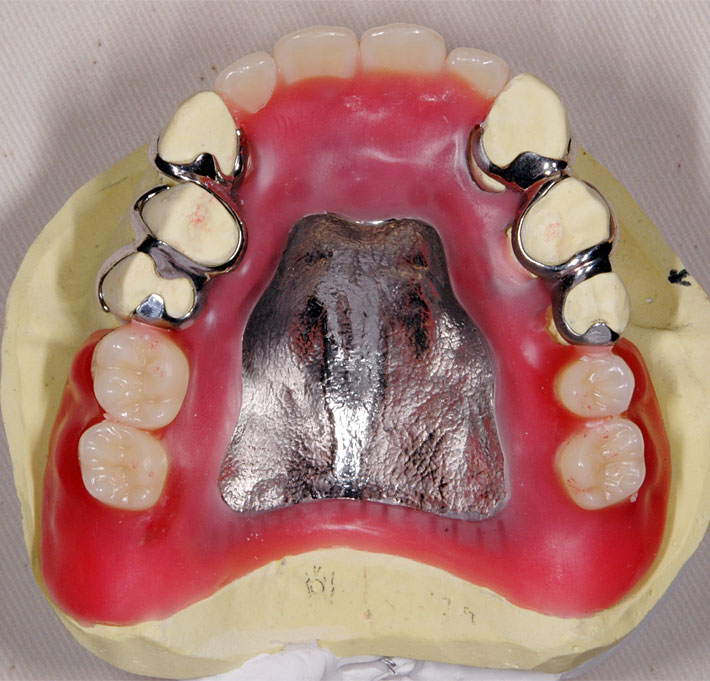 自費の義歯・入れ歯 / 大田区 大森駅前 歯医者さん「内田歯科医院