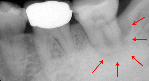 エンド・ぺリオ（歯内歯周病変） | ウケデンタルオフィス・スタッフブログ