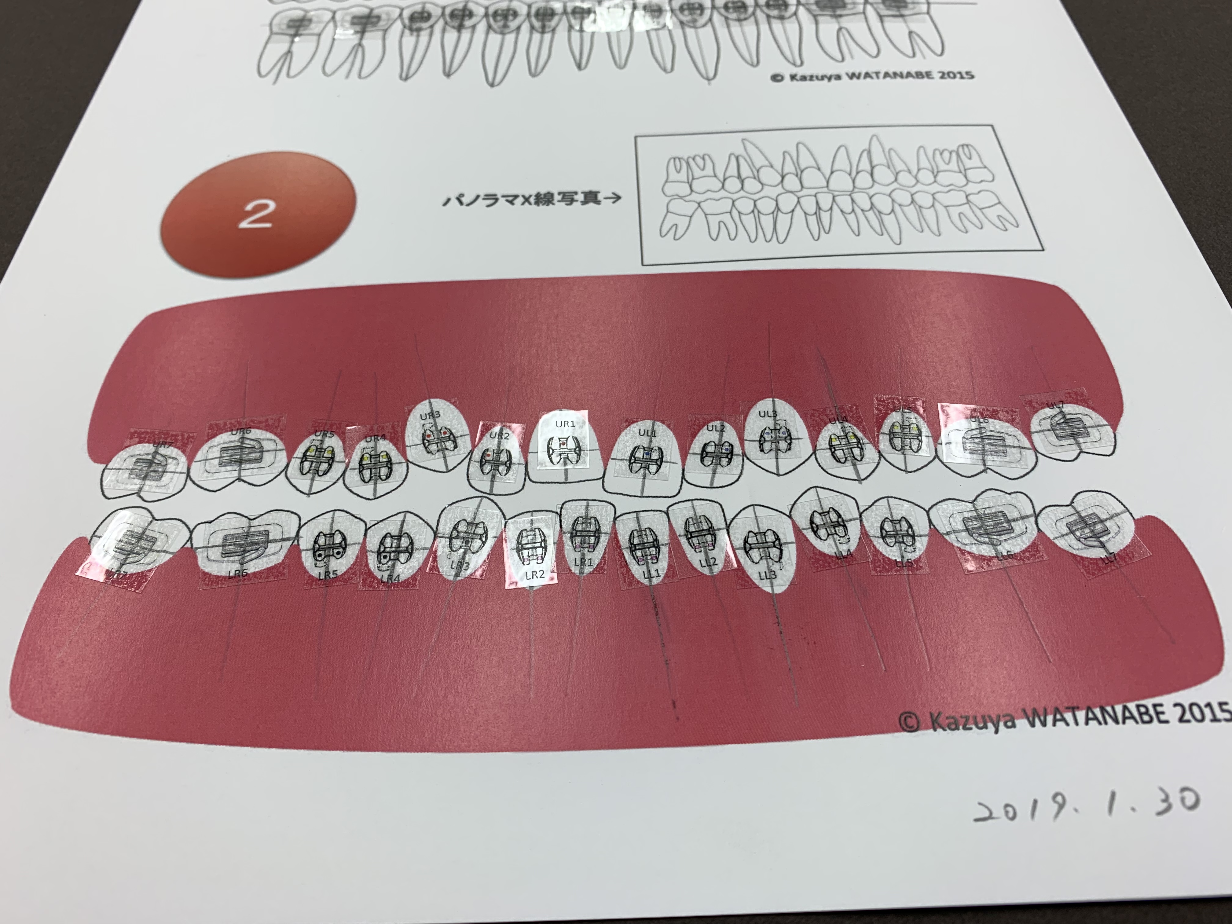 ストレートワイヤーエッジワイズシステムの臨床 | ブログ | 羽村市