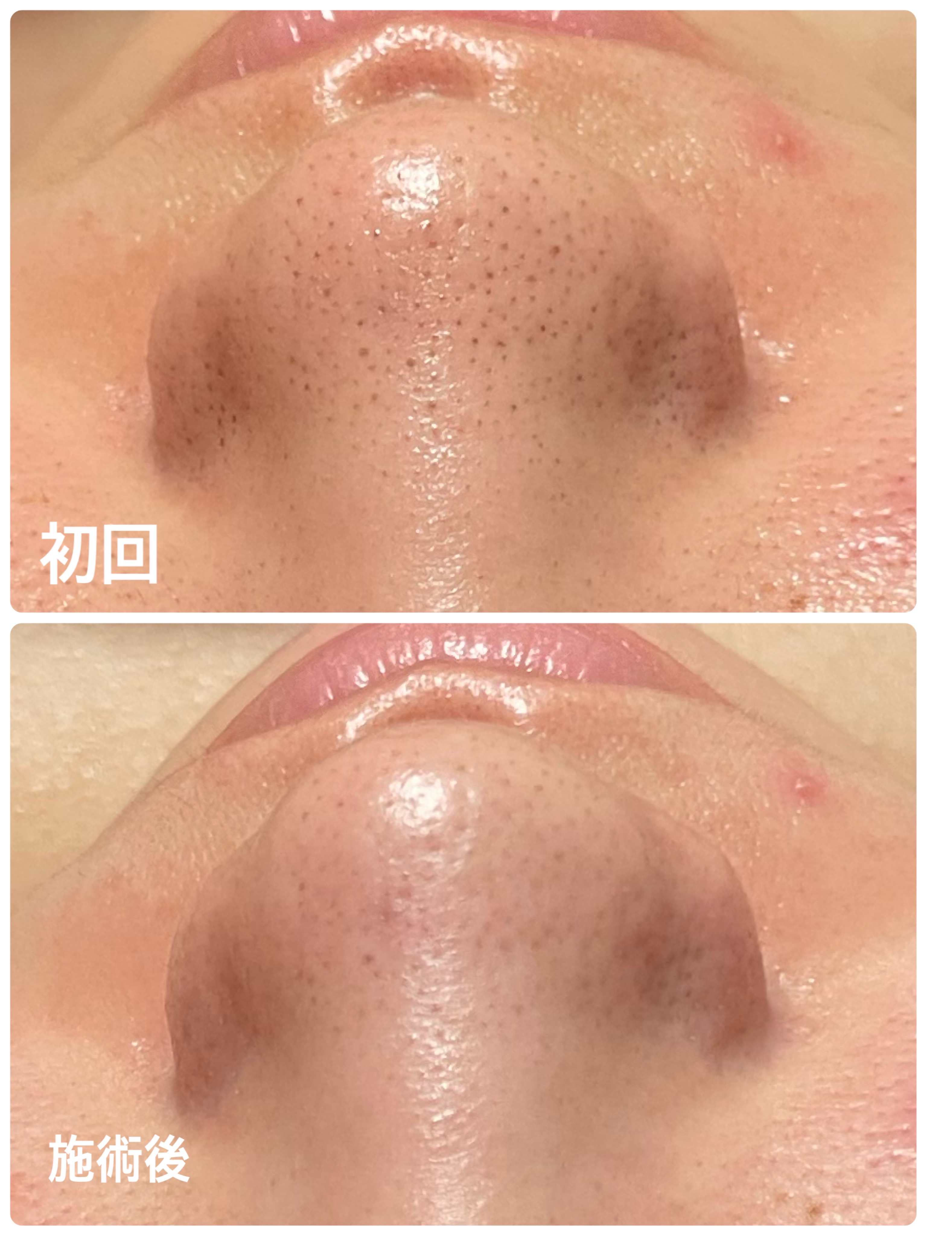 毛穴洗浄 | Total Beauty Salon ViVier