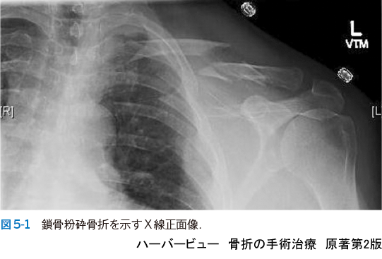 ハーバービュー 骨折の手術治療 原著第2版 - 羊土社