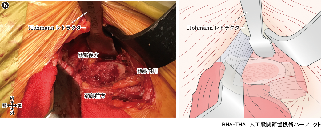 BHA・THA 人工股関節置換術パーフェクト〜人工骨頭置換術・人工股関節