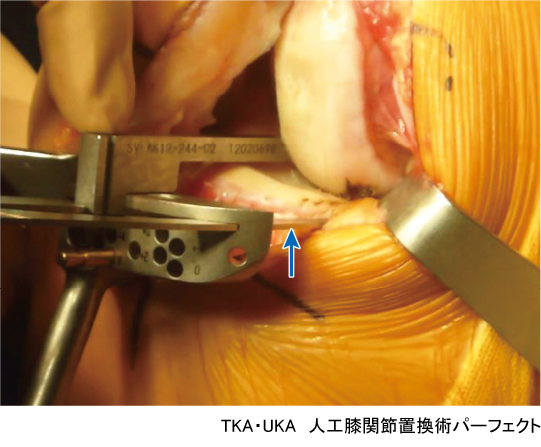 TKA・UKA 人工膝関節置換術パーフェクト〜人工膝関節全置換術・人工膝