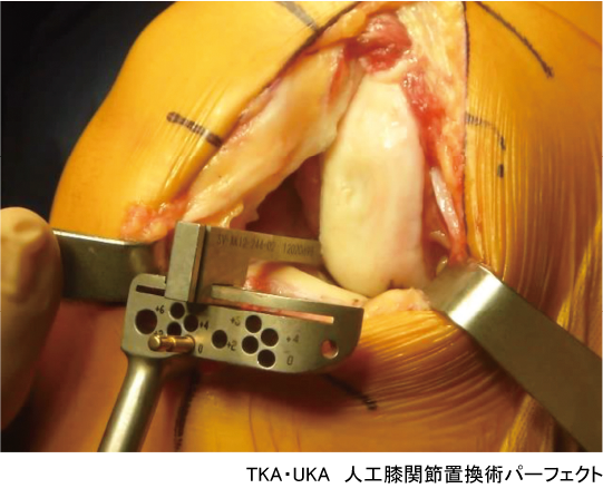 TKA・UKA 人工膝関節置換術パーフェクト〜人工膝関節全置換術・人工膝