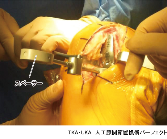 TKA・UKA 人工膝関節置換術パーフェクト〜人工膝関節全置換術・人工膝