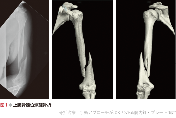 骨折治療 手術アプローチがよくわかる髄内釘・プレート固定 - 羊土社