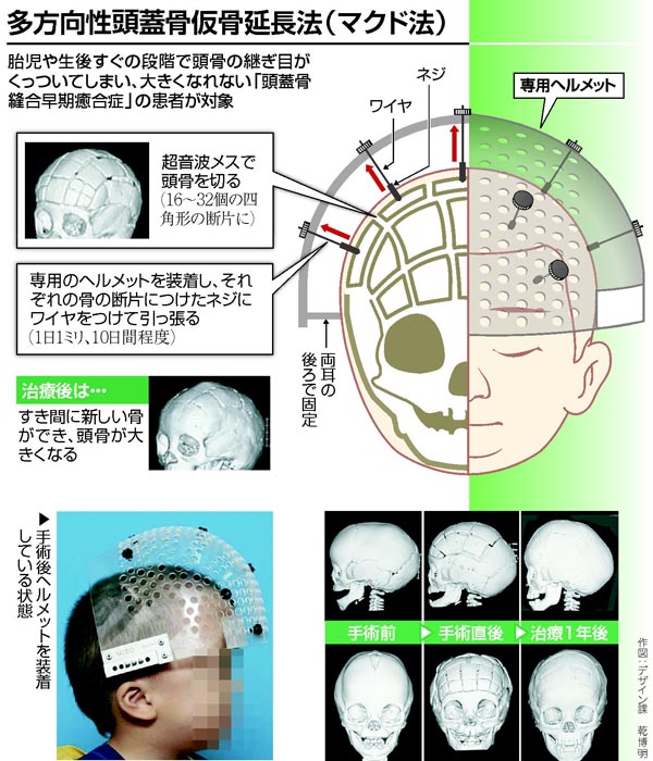 頭蓋骨縫合早期癒合症 骨はがさない新治療 | ヨミドクター(読売新聞)