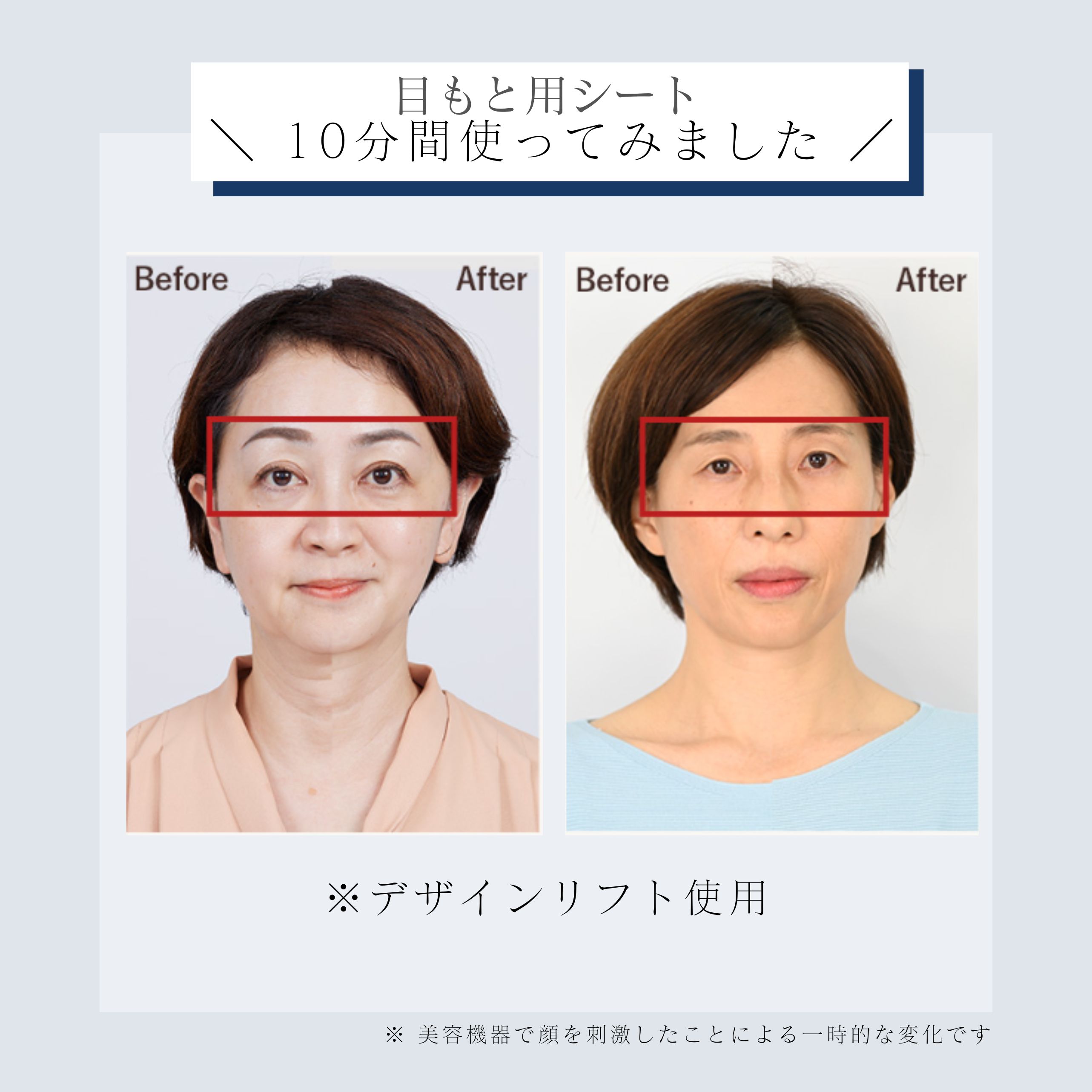 デザインリフトモア口もと集中4ヵ月コースD（C1）｜ヤーマン公式通販