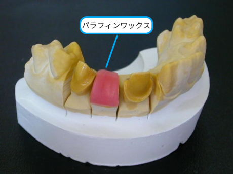 歯科技工Q&A】メタルフレームの製作（前歯メタルセラミック修復物用