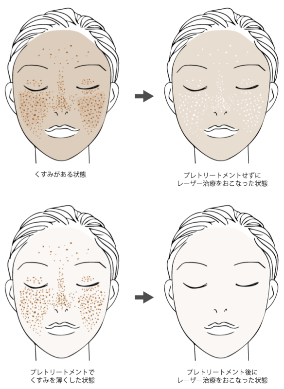 そばかすを全部消すレーザー治療について皮膚科専門医の豊福院長が解説