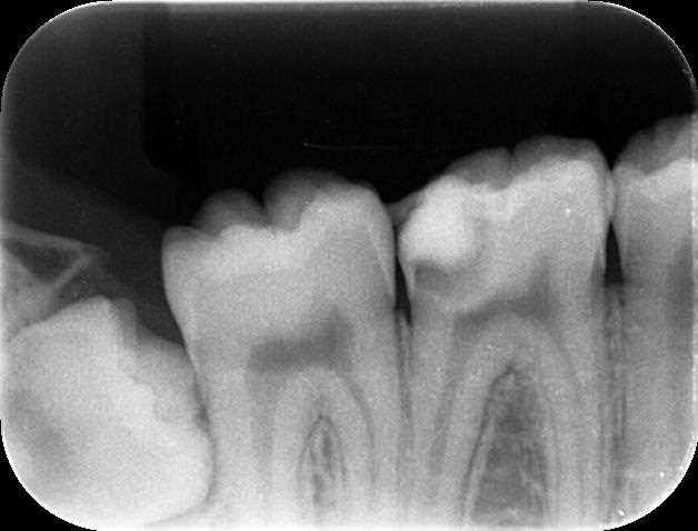 第一大臼歯の虫歯で神経を残す方法｜エルビウムヤグレーザー(Er:YAG