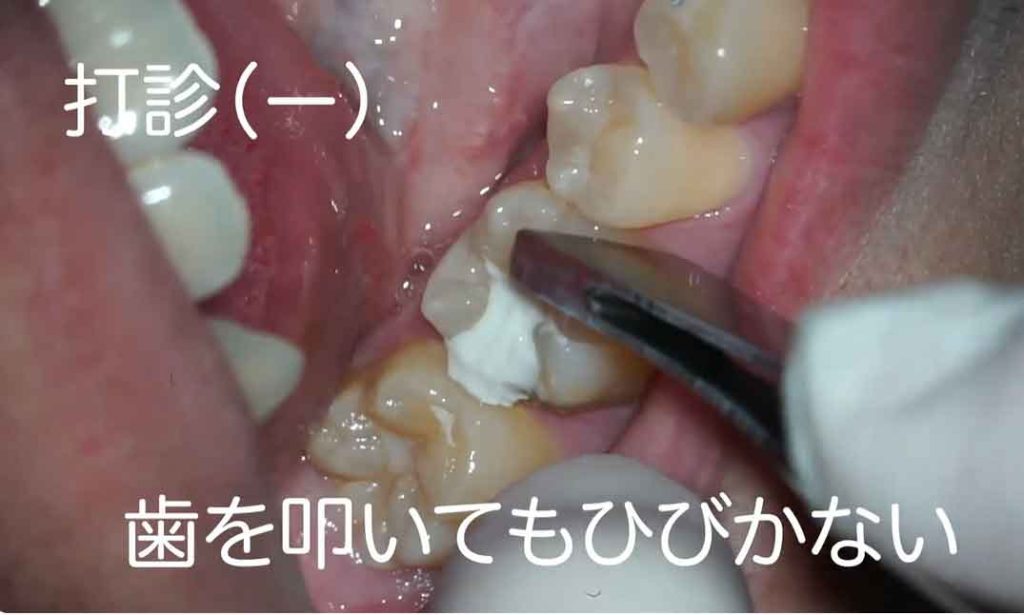 第一大臼歯の虫歯で神経を残す方法｜エルビウムヤグレーザー(Er:YAG