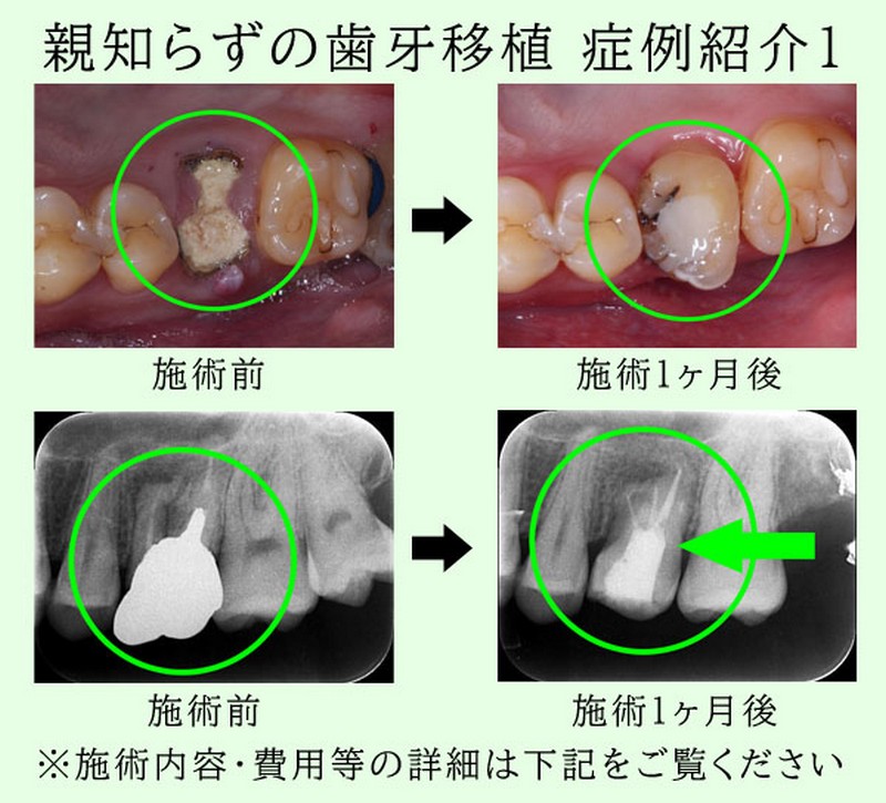 親知らずをインプラント代わりに歯牙移植 症例紹介1 S様20代男性
