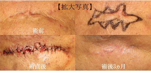 Scar Revision （瘢痕形成術） – 医療法人 双英会 YUKI皮フ科形成外科