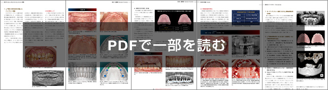 Maxilla-Oriented Implantology 多数歯欠損・無歯顎症例への