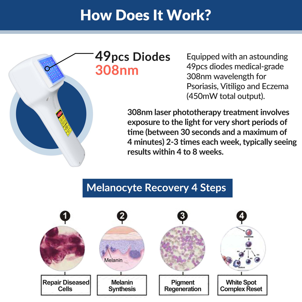 308nm Excimer Uvb Light Therapy Home Use Phototherapy Device for