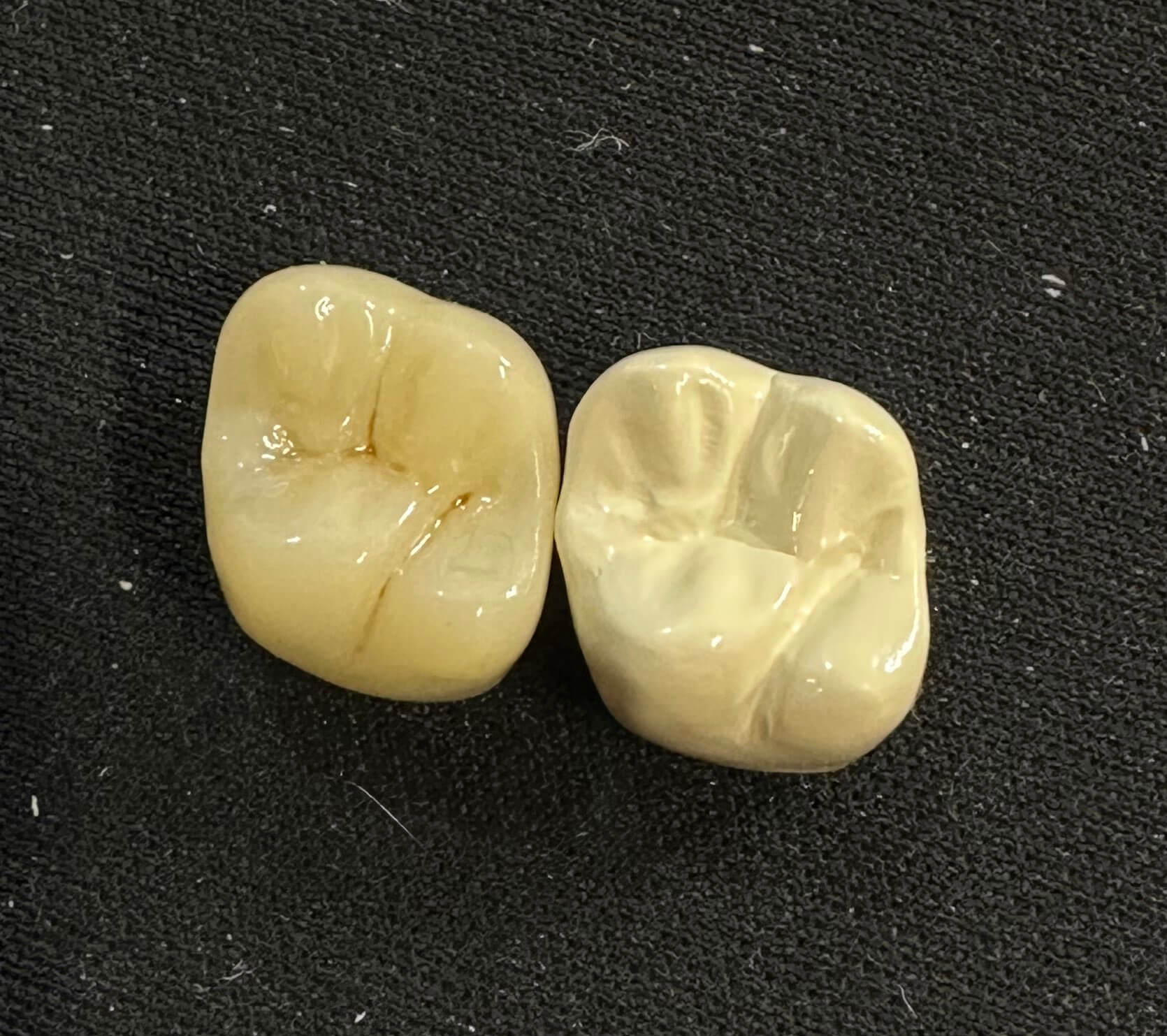 保険でできるPEEK冠について2 | やまのうち歯科医院｜宇都宮市の