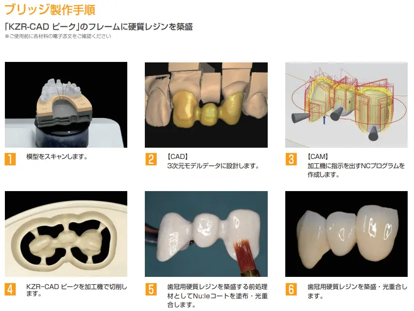 PEEK冠とは？保険適用になった新規材料について特徴を解説 | 八島歯科