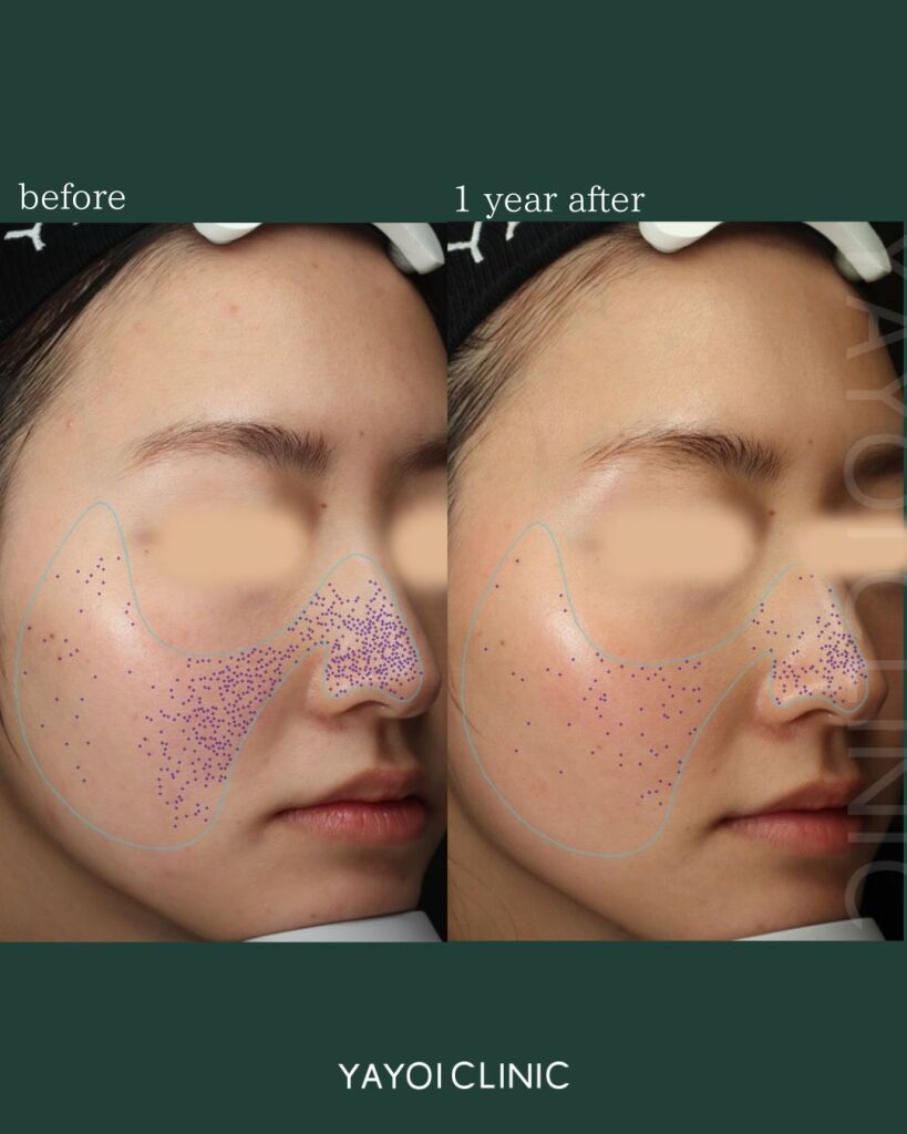 ハイドラフェイシャル｜毛穴の黒ずみ・毛穴洗浄｜広島 ヤヨイ