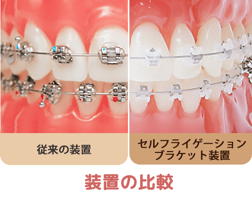エール矯正歯科・こども歯科｜表側の矯正（セルフライゲーション
