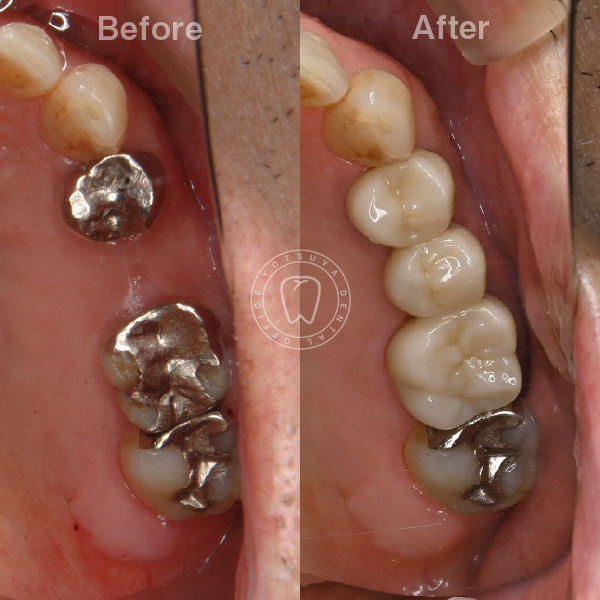 セラミック治療（左上第一小臼歯～第一大臼歯をセラミック治療で