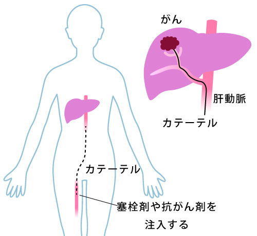 2026年更新】肝動脈塞栓療法(TACE)の効果と特徴を分かりやすく解説