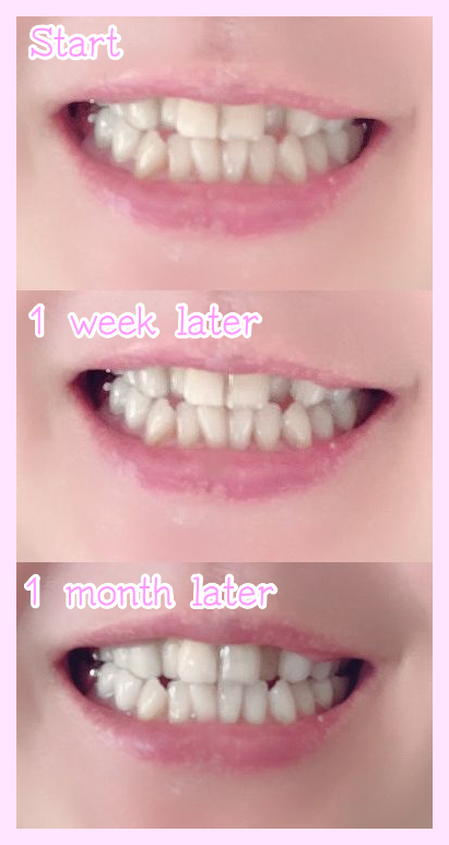 効果なし？】デンタルラバースーパーホワイトLV2を使ってみた私の