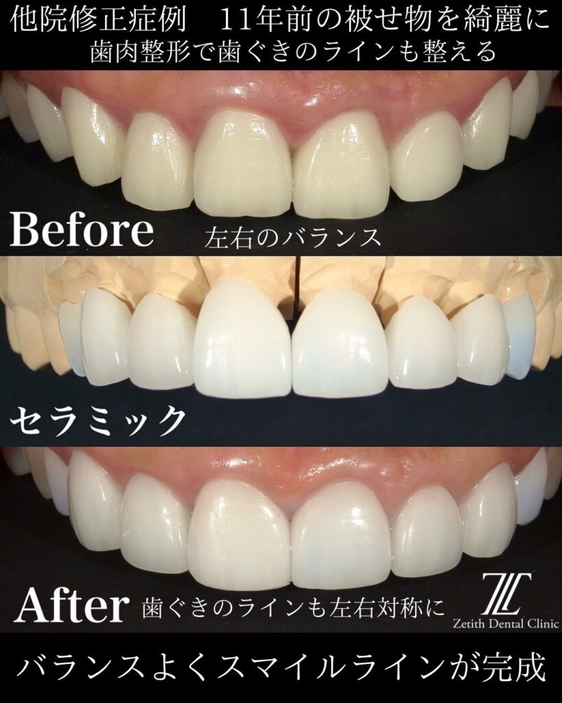 夏の笑顔、今から整える。セラミック治療モニター最大40％OFF｜ゼ