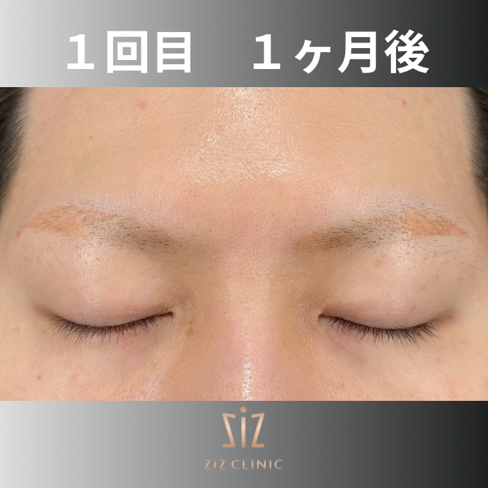 1年前に入れた眉アートメイクを除去したい30代の男性 - タトゥー除去