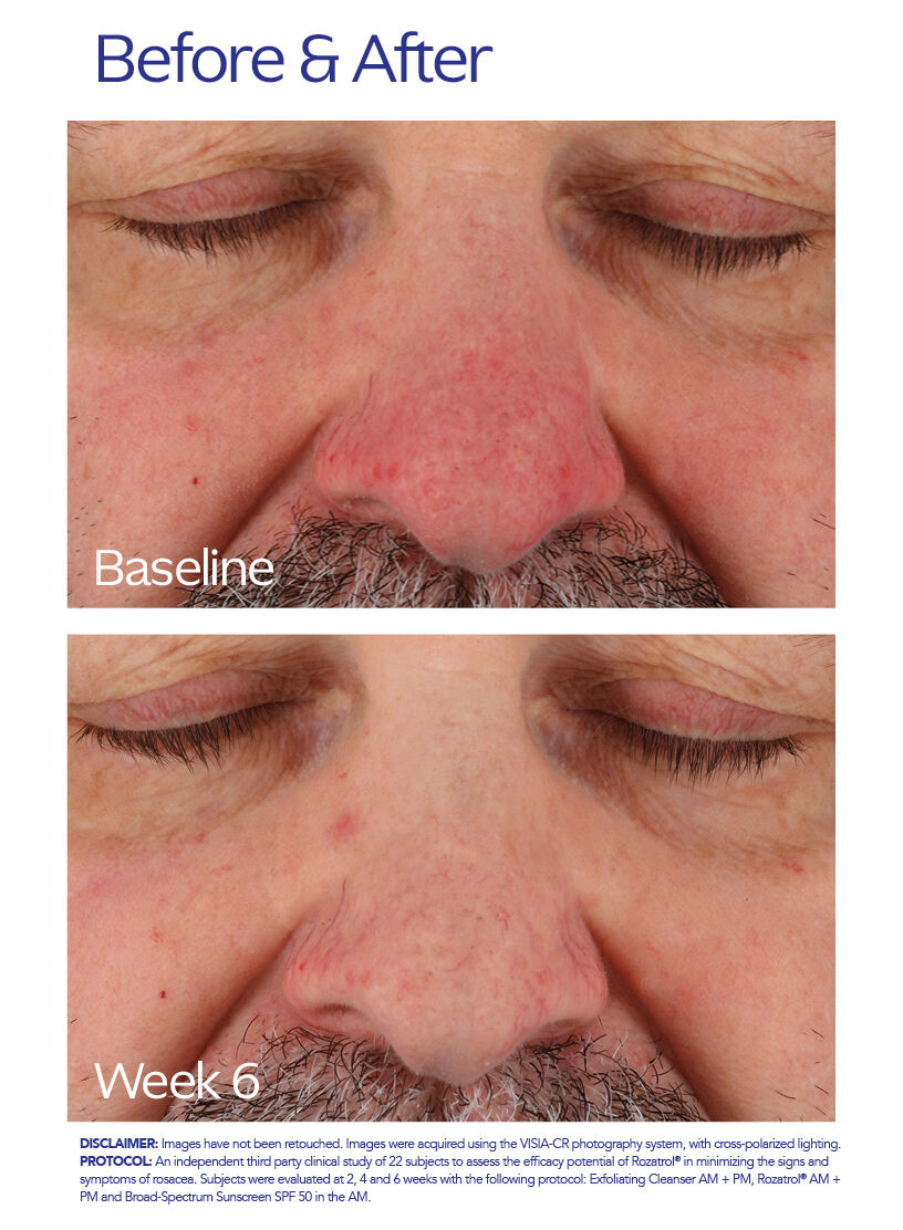 Rozatrol | Redness & Rosacea Serum | ZO Skin Health, Inc.