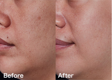 美肌・シミ・くすみ | 美顔レーザ－ | 顔・体のシミ取り | ピコ