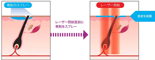 医療脱毛 | ZX-CLINIC【公式】｜大阪梅田・北新地からすぐの安くて承認