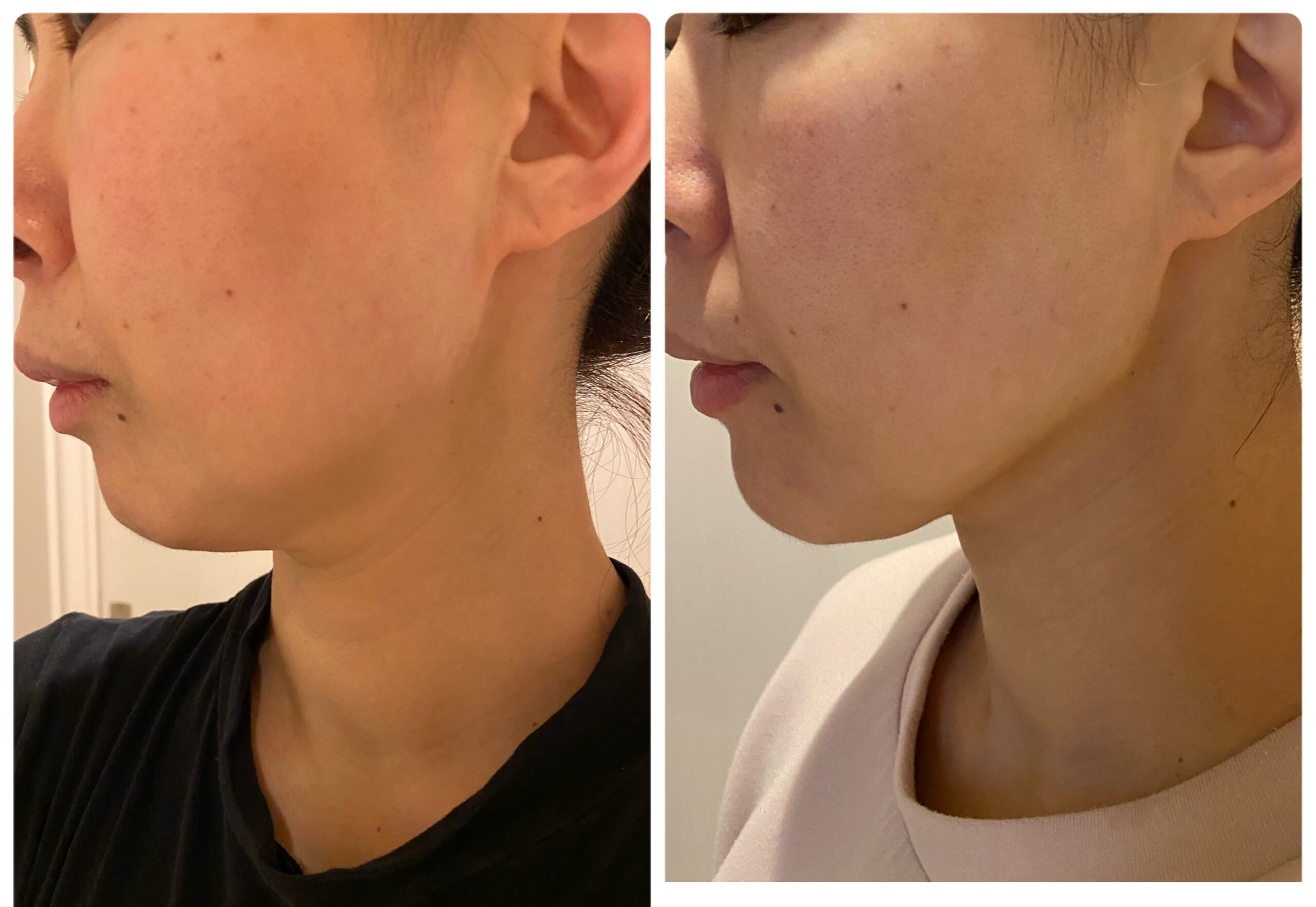 ALOHA レモンボトル、高純度リジュラン、脂燃パッチ 脂肪溶解で小顔に