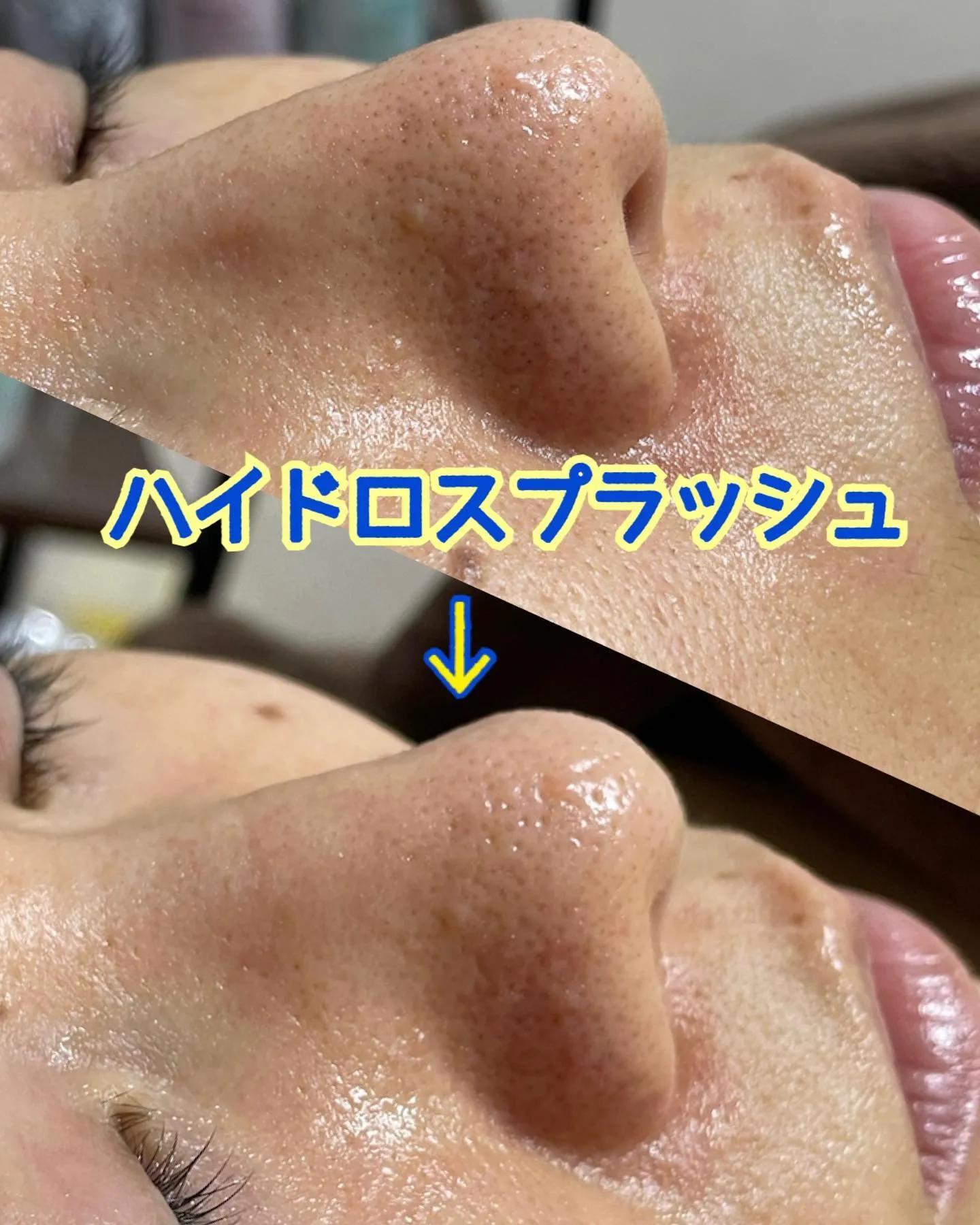 毛穴の洗浄〜ハイドロスプラッシュ〜 | ブログ | 埼玉のエステなら