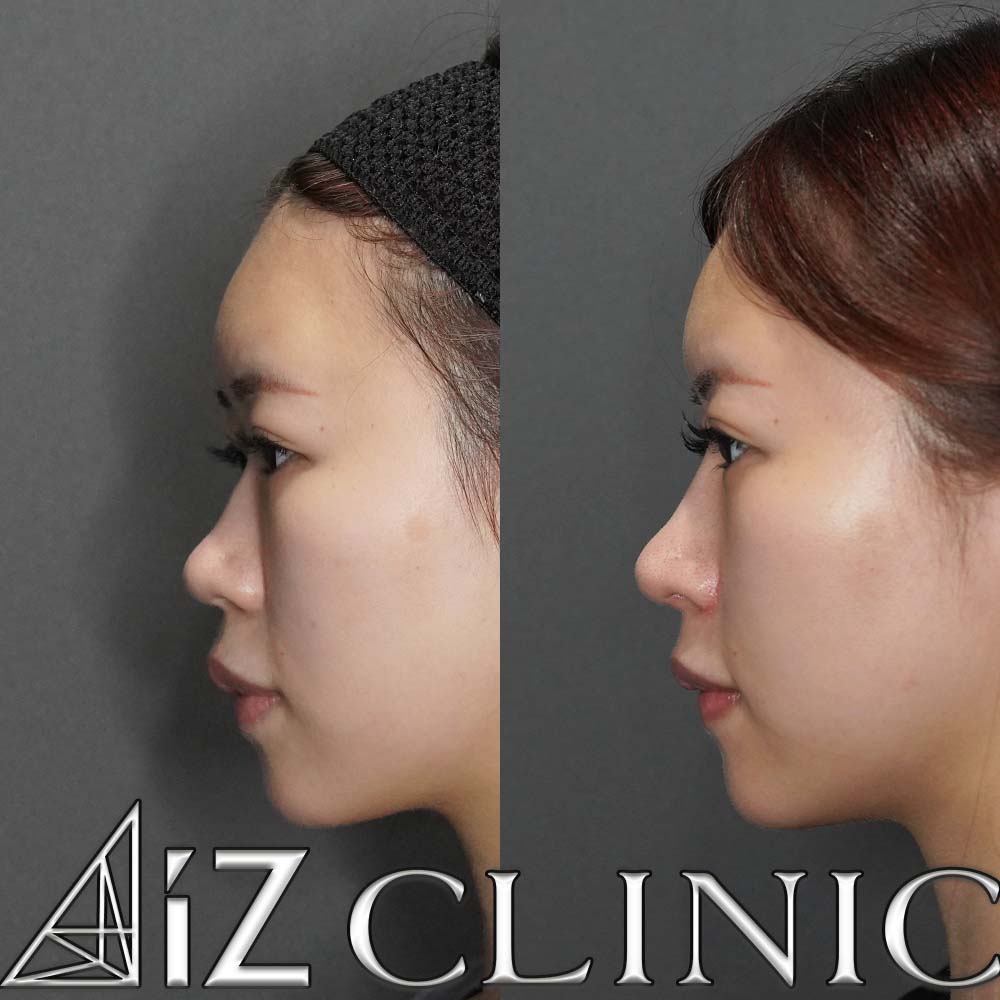 鼻翼縮小で鼻の整形なら美容外科・美容皮膚科AiZクリニック ｜AiZ