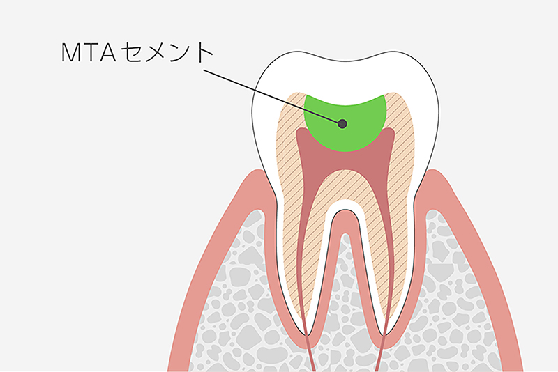 精密歯髄温存療法 ｜谷町四丁目の歯医者｜&DENTAL谷町4丁目歯科・矯正