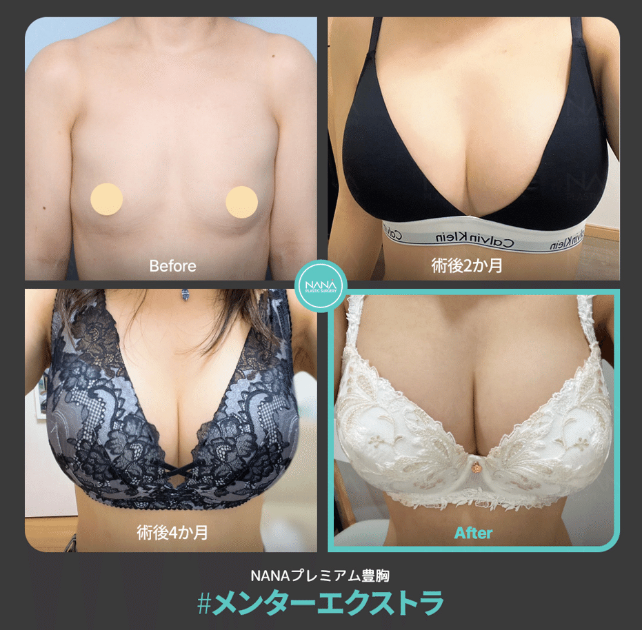 豊胸再手術の改善効果を専門医が解説します～形、感触、サイズなど